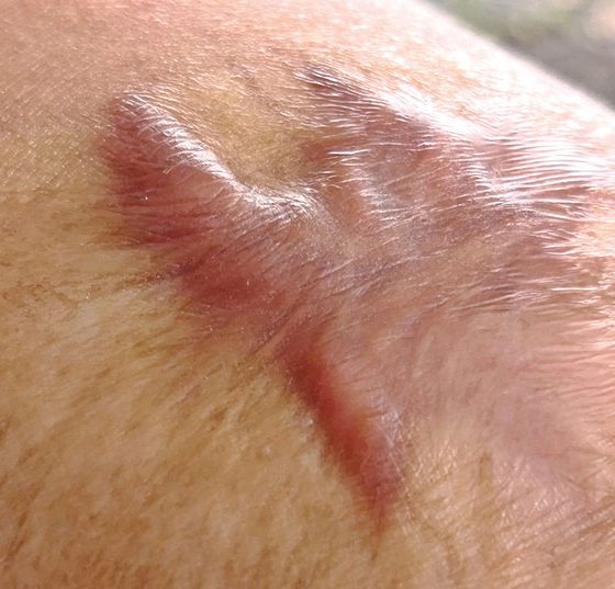 keloid_istock-1001378268