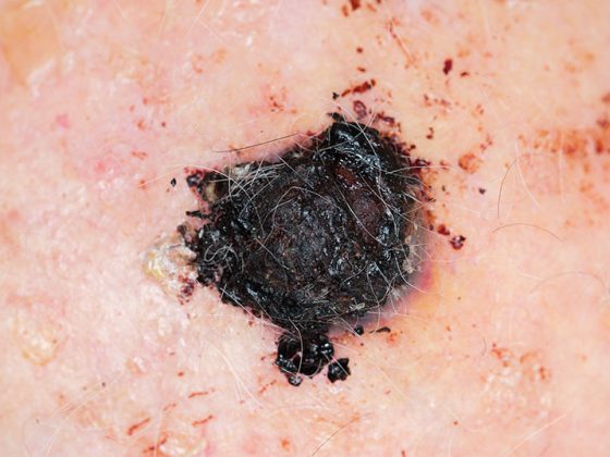 melanom_istock-1091664176