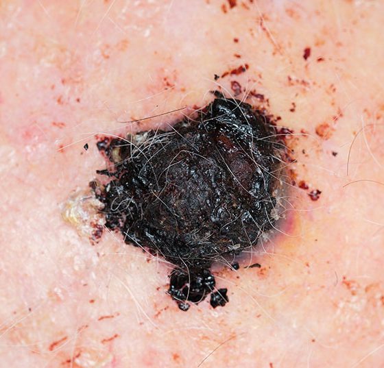 melanom_istock-1091664176