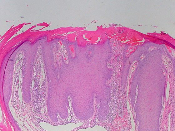 prurigo_nodularis_5078047877