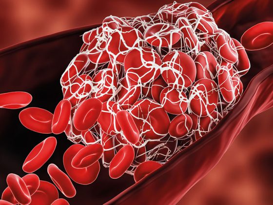 blutgerinnsel_istock-1297034329