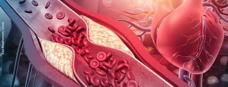 cholesterin_herz_istock-1293132839
