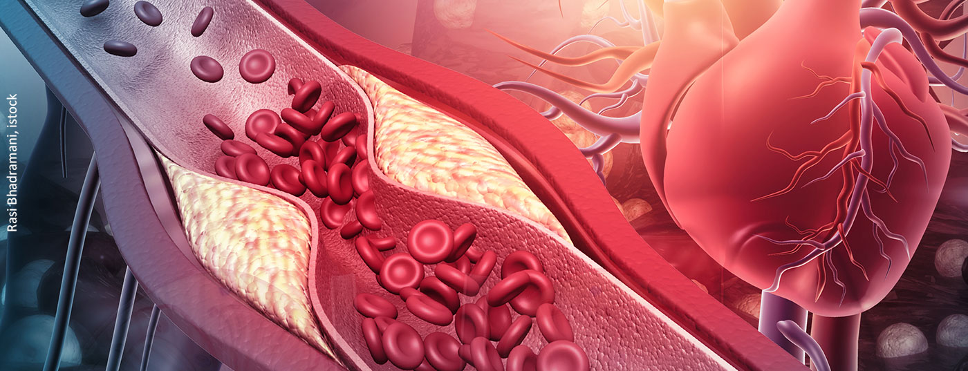 cholesterin_herz_istock-1293132839