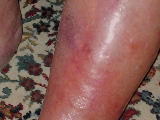 ersypel_istock-181147103