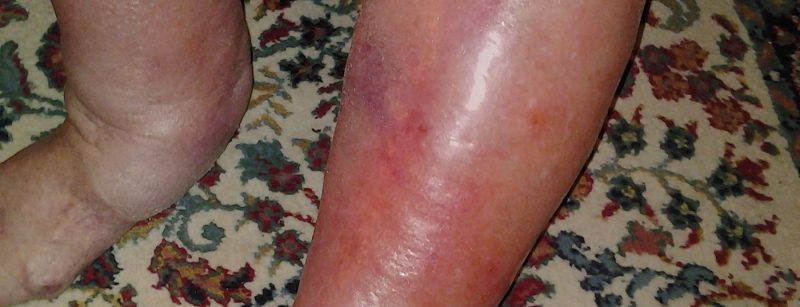 ersypel_istock-181147103