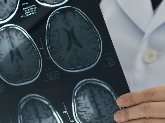 gehirn_mri_ct-scan_istock-862563174