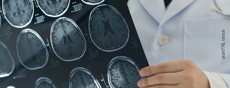 gehirn_mri_ct-scan_istock-862563174