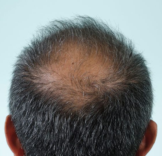 glatze_istock-184378269