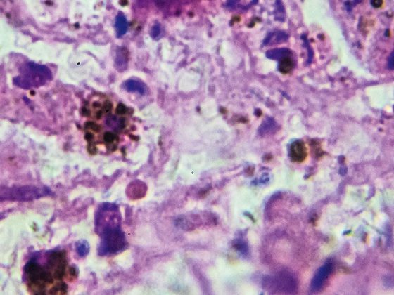 melanom_biopsie_istock-908465636