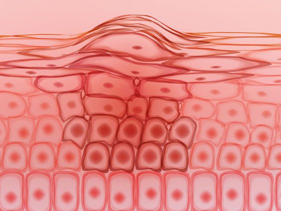 melanom_hautzellen_istock-1257071953