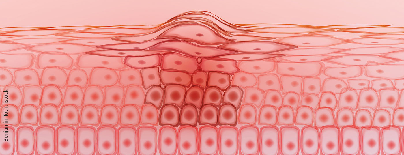 melanom_hautzellen_istock-1257071953