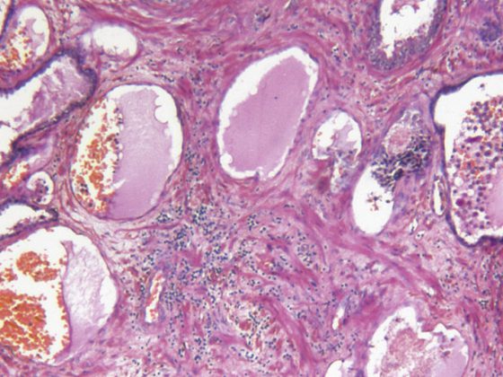 prostatakrebs_istock-182444544