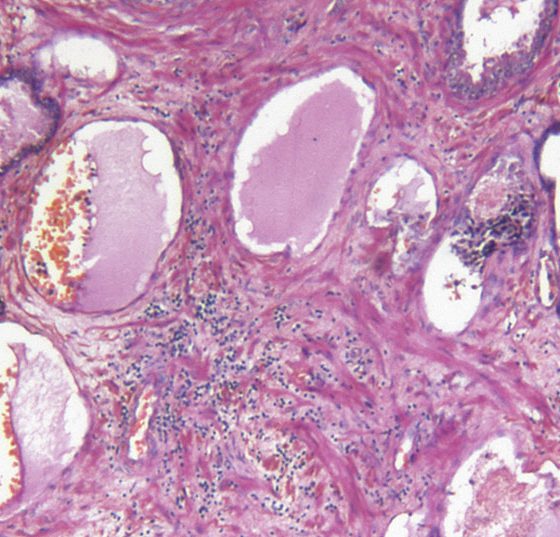 prostatakrebs_istock-182444544