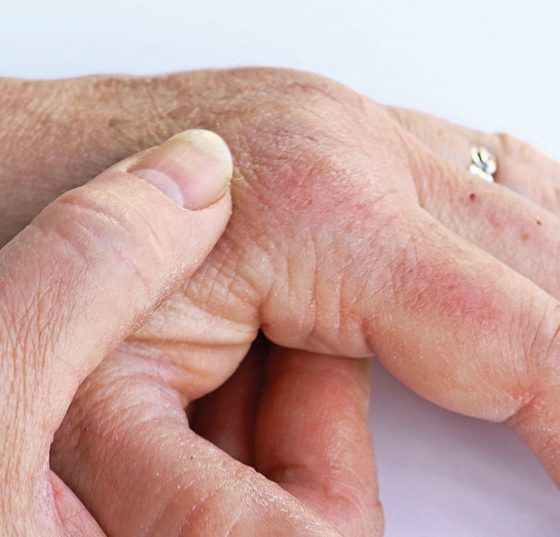 psoarthritis_istock-684565114