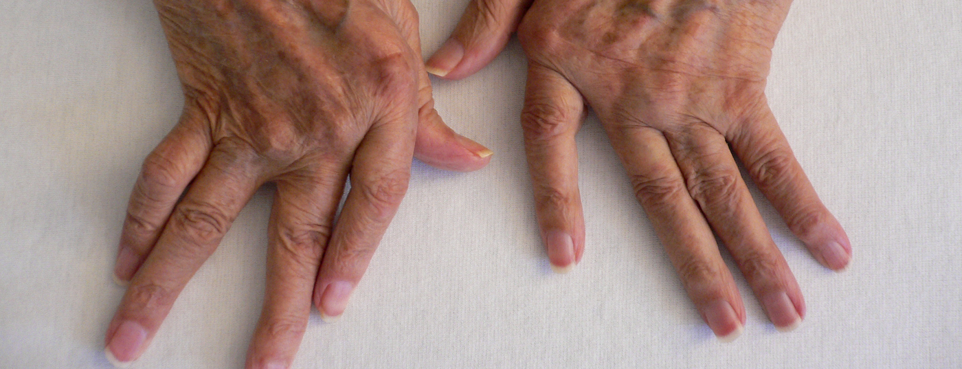rheuma_arthritis_hand2