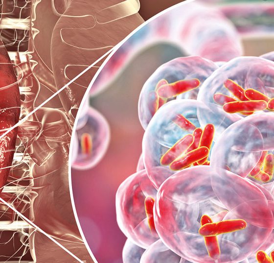 tuberkulose_istock-1015930876