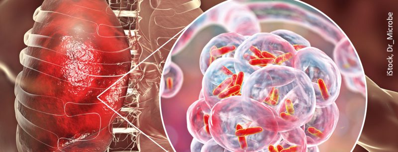 tuberkulose_istock-1015930876