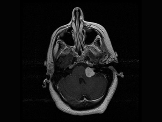 vestibular-schwannoma-003
