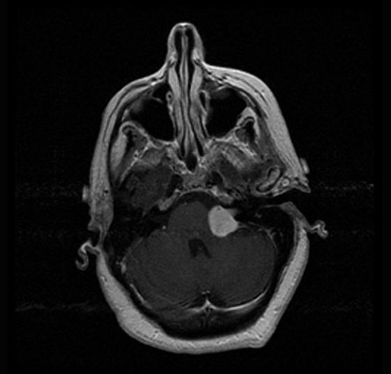 vestibular-schwannoma-003