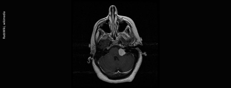 vestibular-schwannoma-003