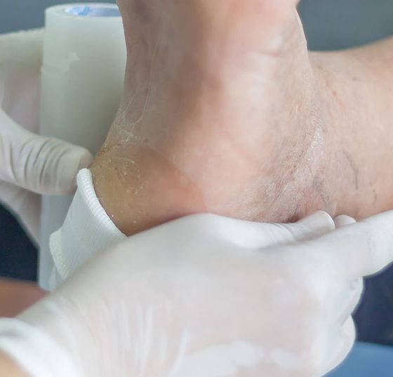 fuss_diabetes_wunde_istock-823680582