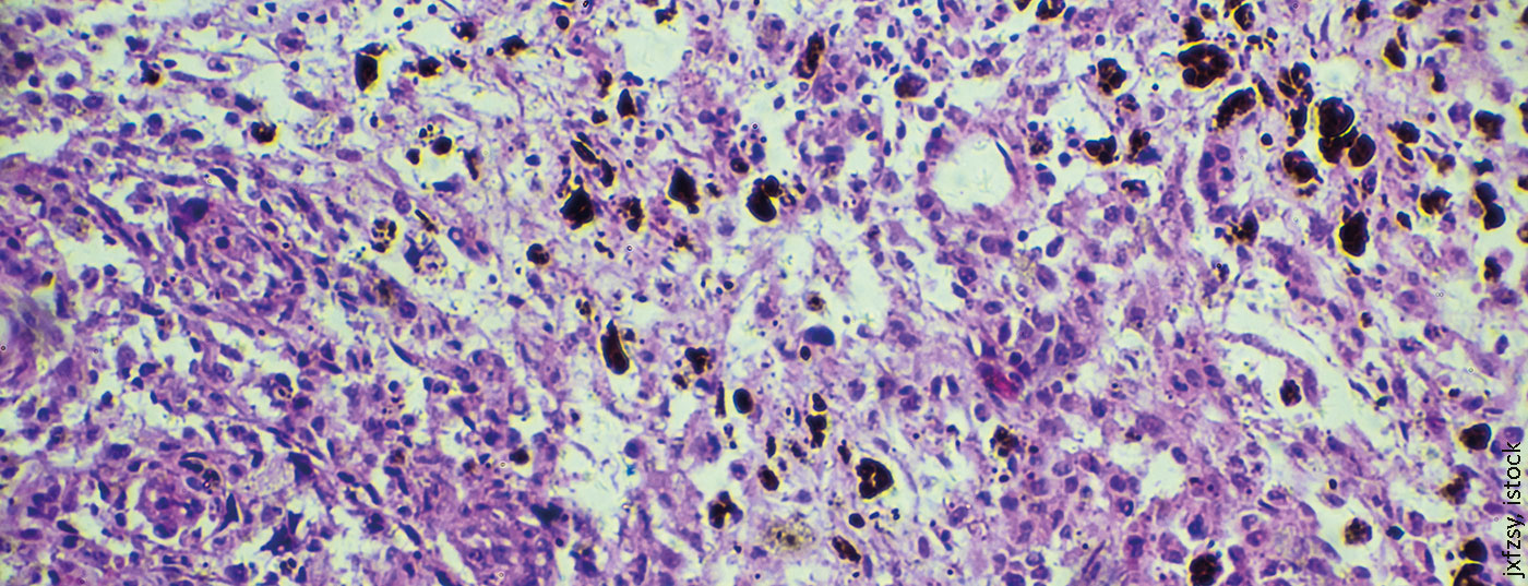 melanom_biopsie-istock-908464974