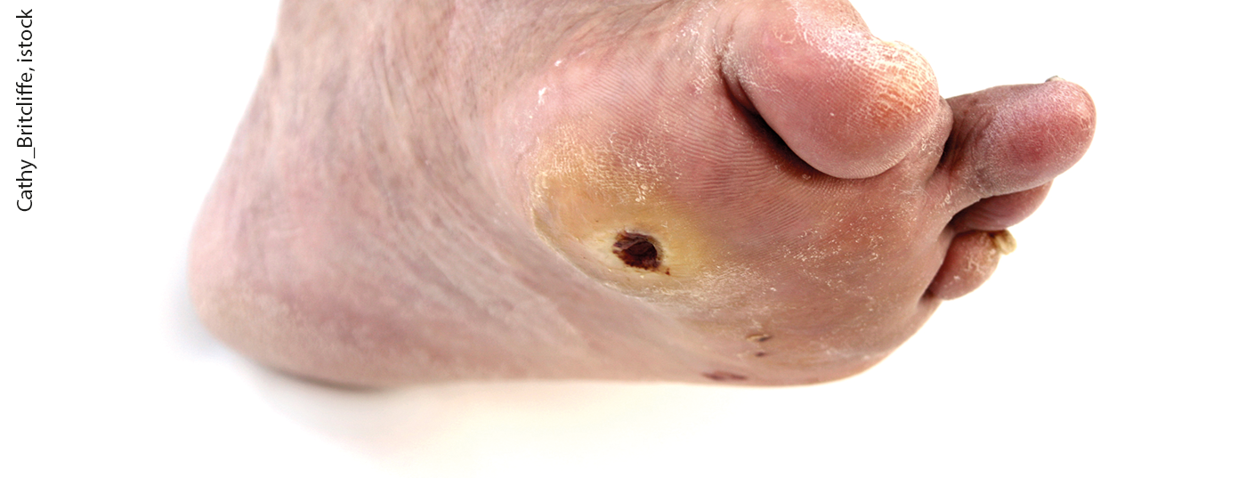 ulcus_diabetes_istock-185283483