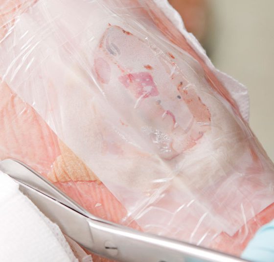 wunde_istock-171153394