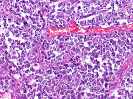 diffuse_large_b-cell_lymphoma_dlbcl_high_mag