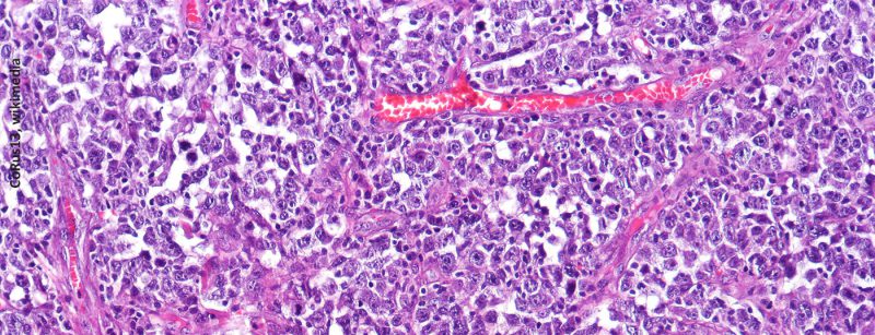 diffuse_large_b-cell_lymphoma_dlbcl_high_mag