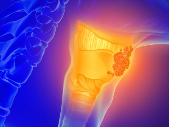 hals_krebs_kehlkopf_istock-1130880428