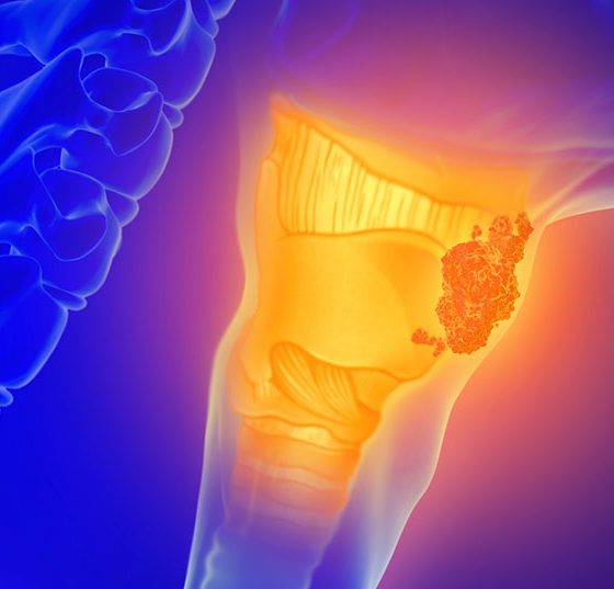 hals_krebs_kehlkopf_istock-1130880428