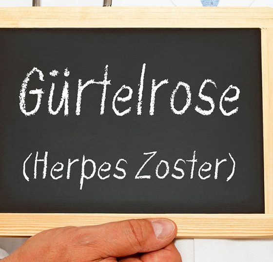 herpes_zoster_guertelrose