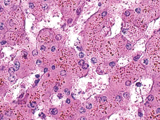 leber-haemosiderose_istock-1346440836