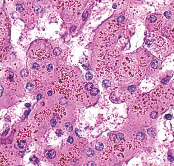 leber-haemosiderose_istock-1346440836