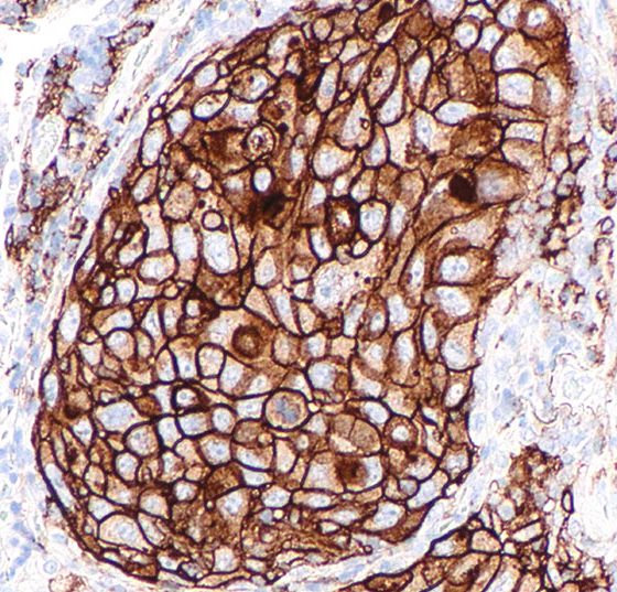 nsclc_lungenkrebs_nicht_kleinzellig