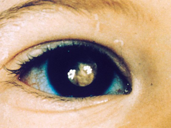 retinoblastoma