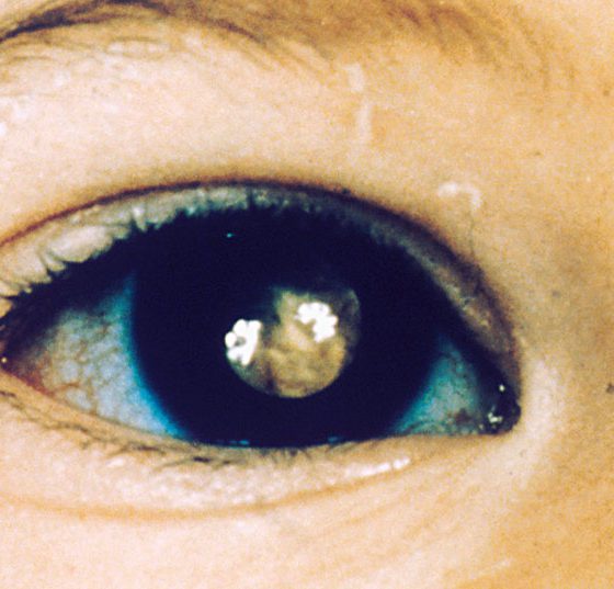 retinoblastoma