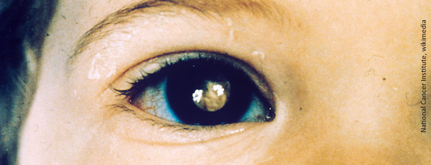 retinoblastoma