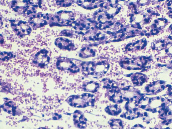 schilddruesenkarzinom_istock-902060846-2