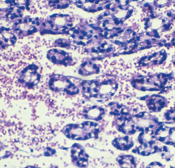 schilddruesenkarzinom_istock-902060846-2