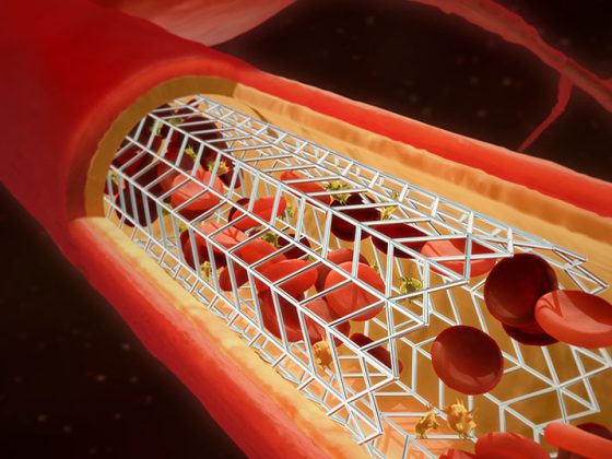 stent_istock-1224997413