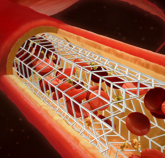 stent_istock-1224997413