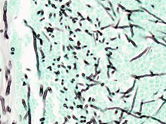 aspergillose_wikimedia