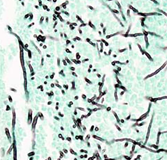 aspergillose_wikimedia