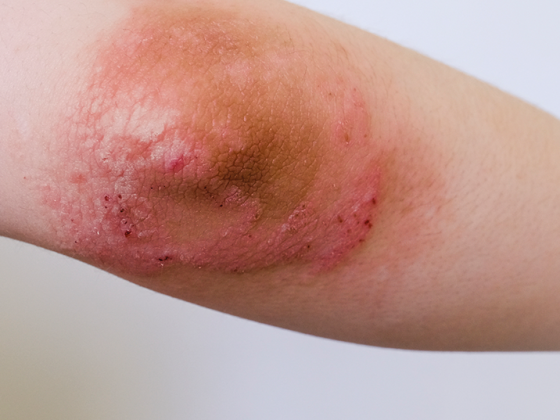 atop_dermatitis_istock-1248124105