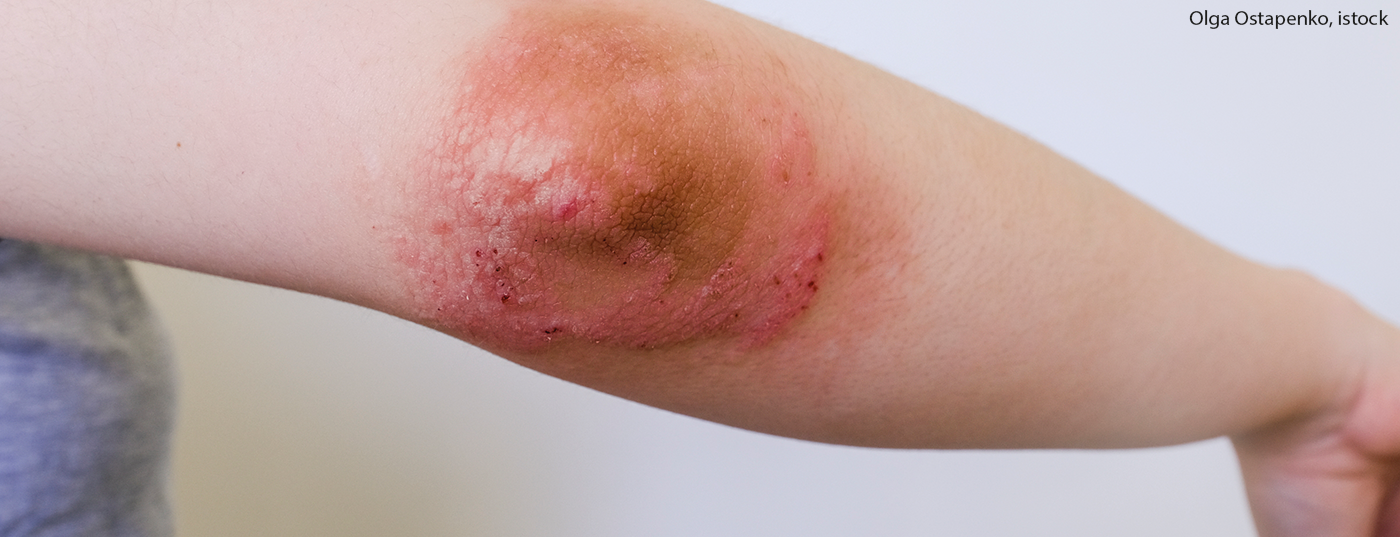 atop_dermatitis_istock-1248124105