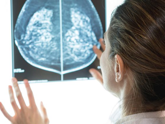 brustkrebs_istock-917730078