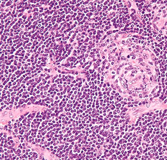 castleman_disease_-_high_mag