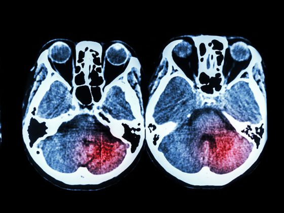 gehirn_mri_stroke_istock-475149924